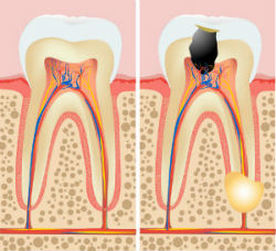 Endodontics | General Dentistry of Cape Cod | Dentist Hyannis, MA