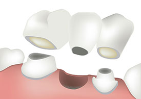 Dental Bridges | General Dentistry of Cape Cod, PC | Hyannis, MA