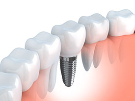Dental Implants | General Dentistry of Cape Cod, PC | Hyannis, MA